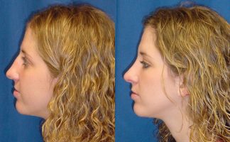 Before and after photo of an actual Rhinoplasty patient.