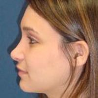 A side view profile photo of a woman's face, showing the result of a rhinoplasty.
