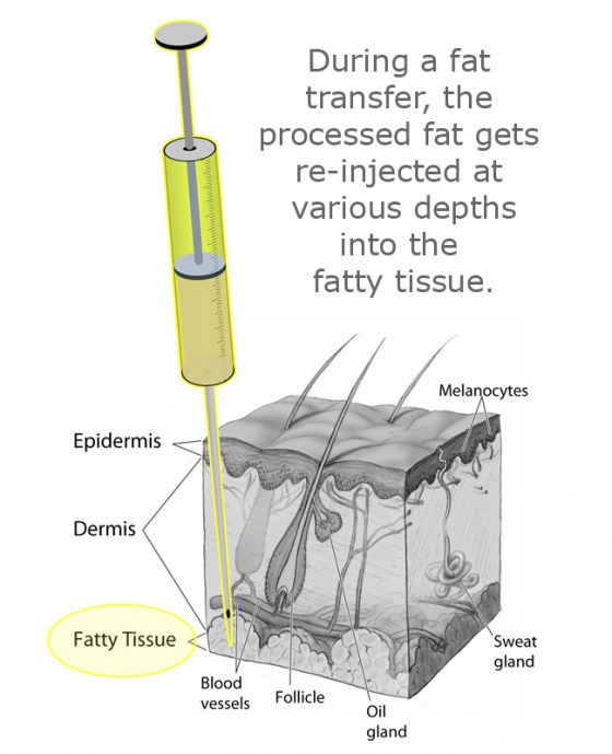 An illustration of fat injection subcutaneous planes.
