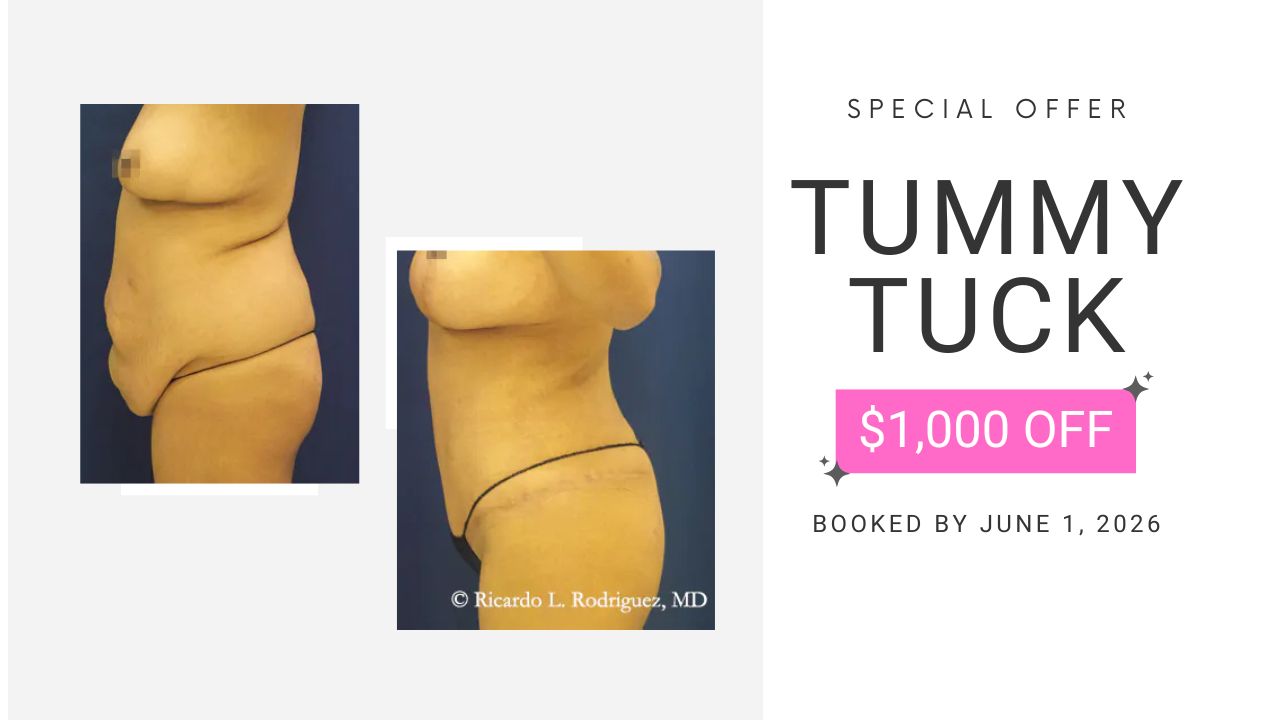 before and after tummy tuck patient photos with special offer tummy tuck $1000 off