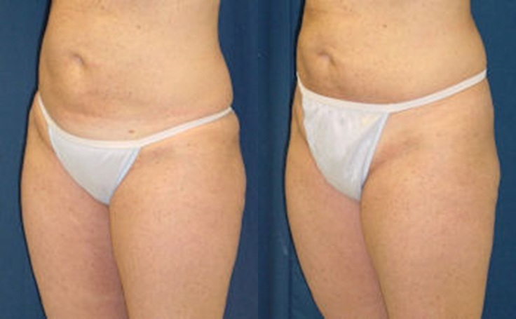 Before and after photo of an actual Thigh Lift patient.