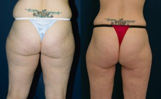 Before and after photo of an actual Thigh Lift patient.