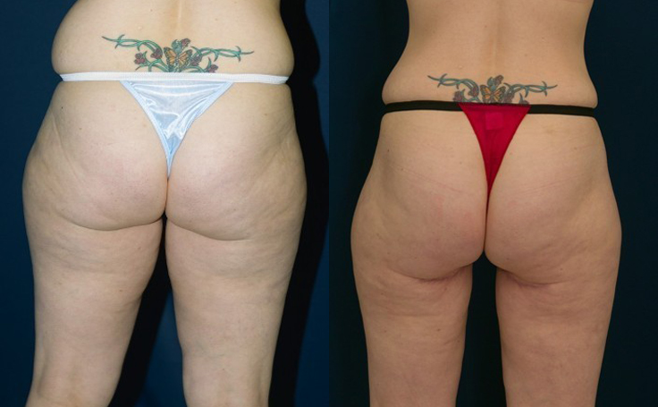 Before and after photo of an actual Thigh Lift patient.