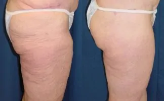 Before and after photo of an actual Thigh Lift patient.