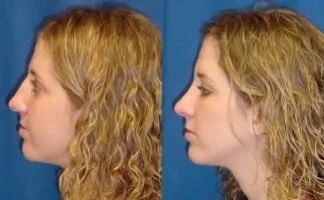 thumbnail side views before and after of a rhinoplasty patient