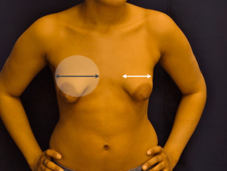 Tubular (Tuberous) breast shape - How to correct with implants -  Cosmeticsurg