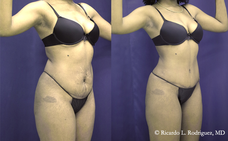 before and after tummy tuck with liposuction patient