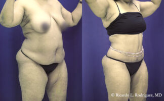 before and after tummy tuck with liposuction patient