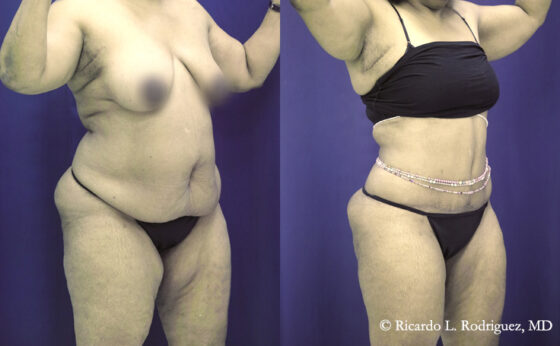 Before & After Lipo of flanks - Dr. Rodriguez, Cosmeticsurg