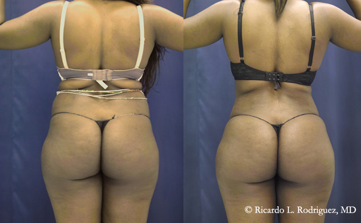 before and after tummy tuck with liposuction patient