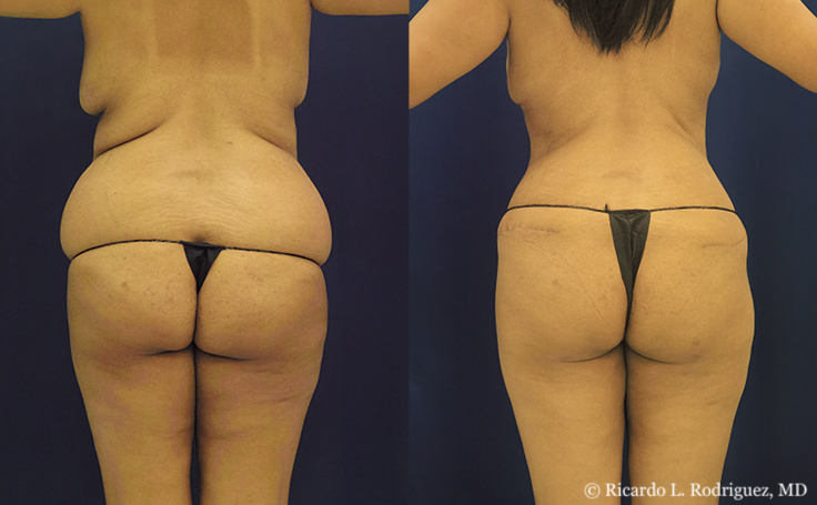 before and after an extended tummy tuck (back view)