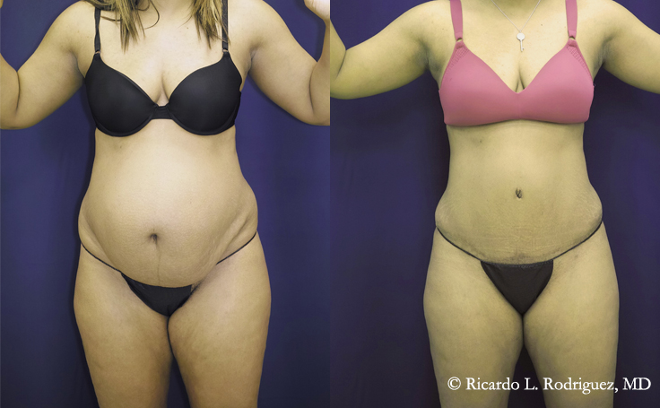 before and after a tummy tuck with liposuction