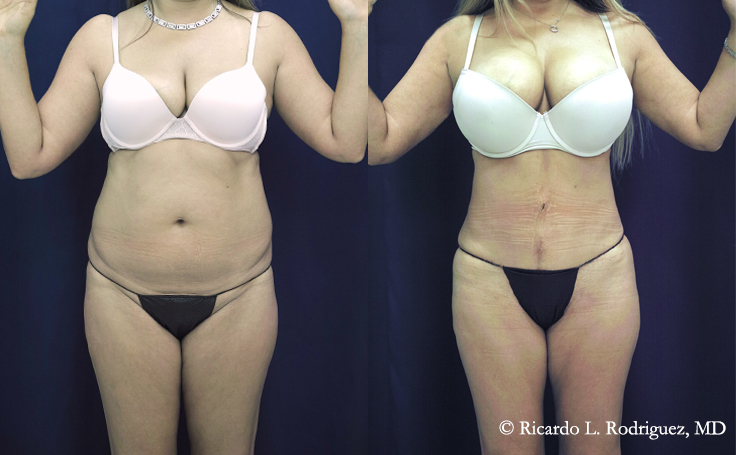 before and after a tummy tuck and brazilian butt lift