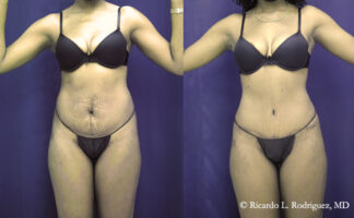 plastic surgery patient before and after tummy tuck and liposuction procedure