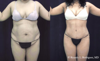 tummy tuck with liposuction patient before and after her procedure