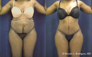 before and after a tummy tuck and liposuction