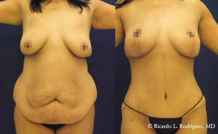 before and after an extended tummy tuck and breast lift, front view