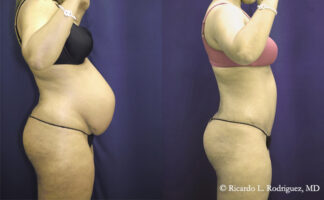 before and after a tummy tuck with liposuction