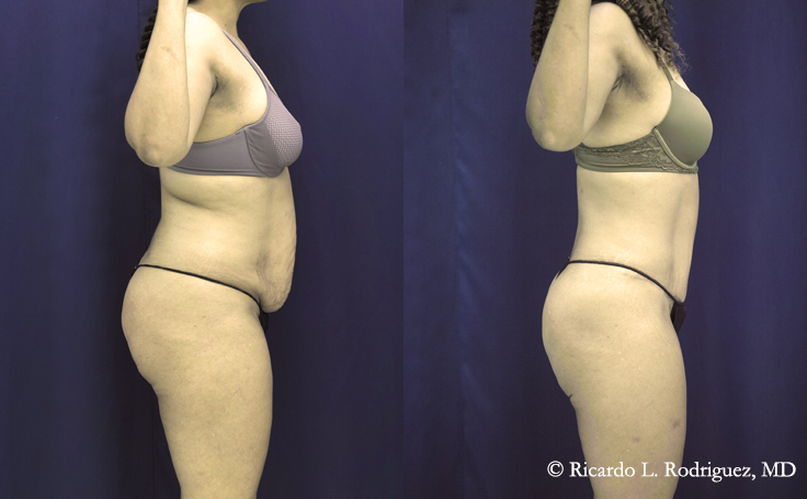 Before & After Tummy Tuck with lipo (3100 cc fat extracted) - Dr.  Rodriguez, Cosmeticsurg