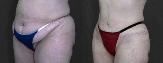 tummy tuck patient before and after