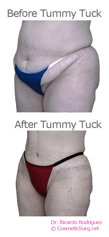 Before & after Tummy tuck patient profile photos..