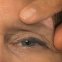 A photo of a patient's left eye, showing the area above the eye that needs to be corrected.