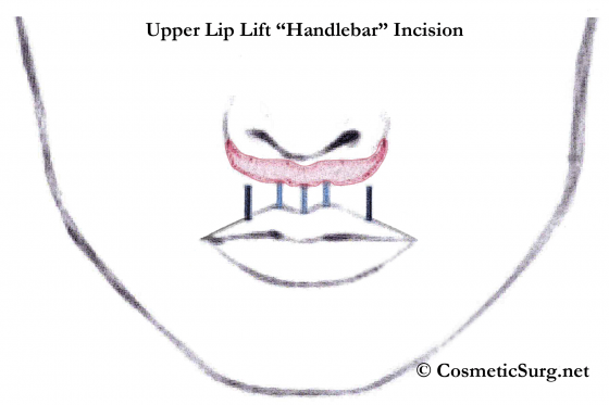 Upper lip lift illustration showing the handlebar incision.