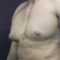 oblique view of a male chest prior to gynecomastia surgery